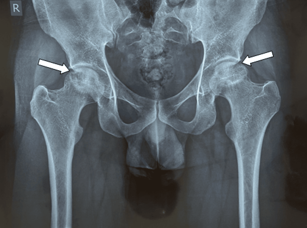 avascular necrosis (avn) melbourne