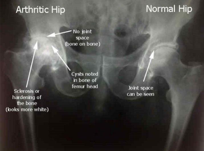 hip osteoarthritis