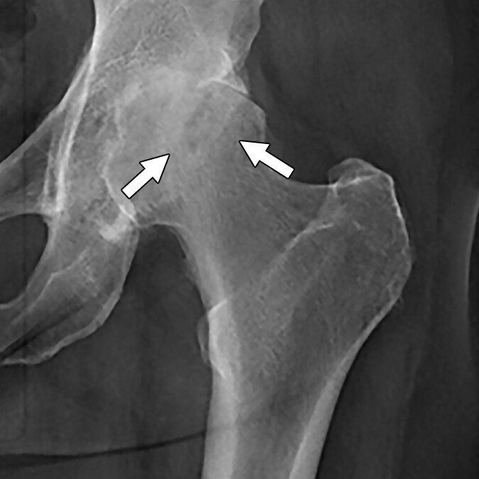 hip osteonecrosis