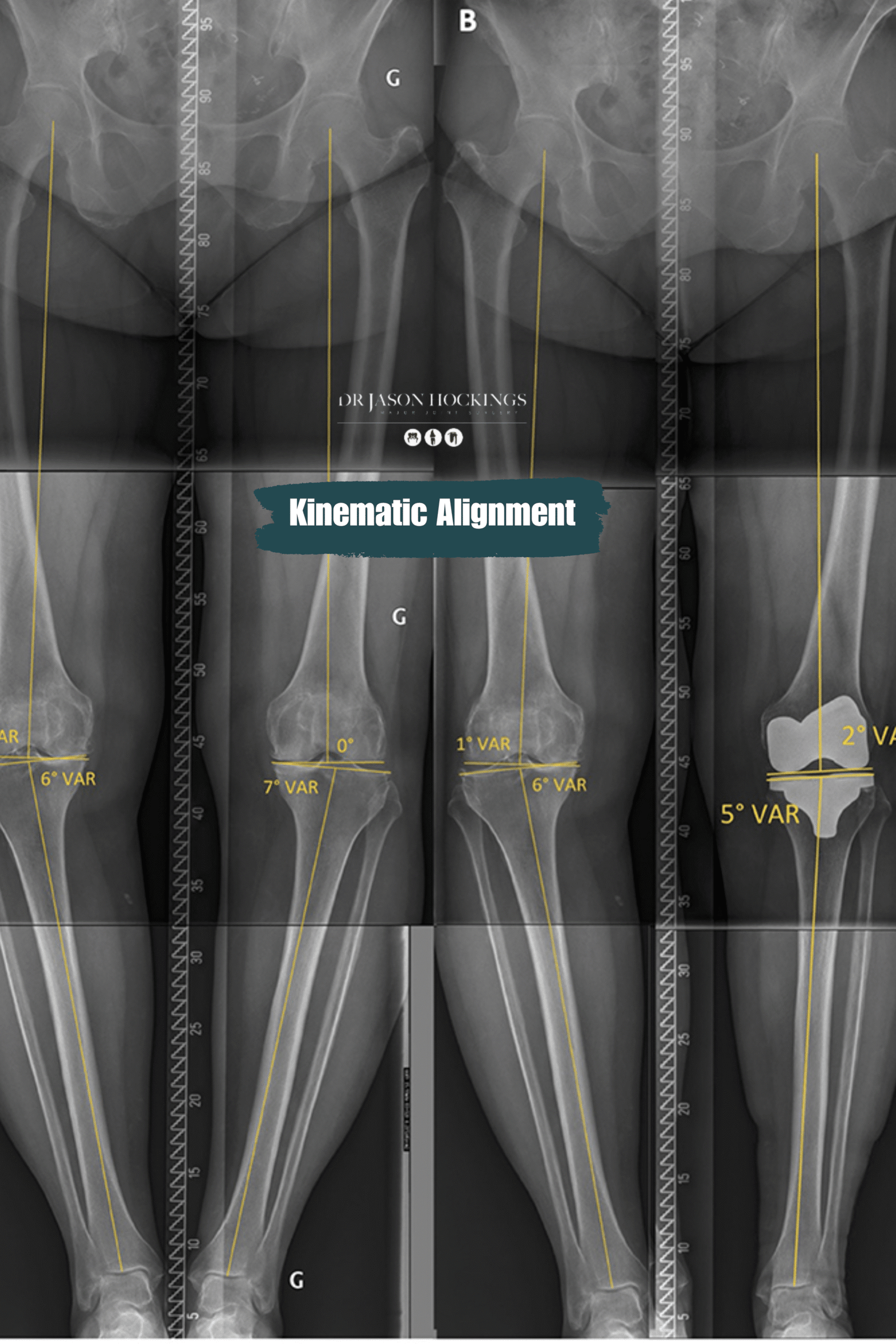 kinematic alignment dr jason hockings (1)