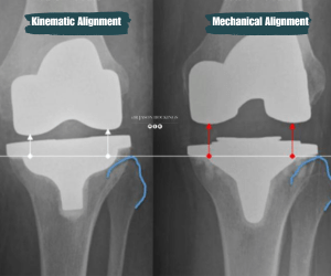 kinematic alignment vs mechanical alignment tka