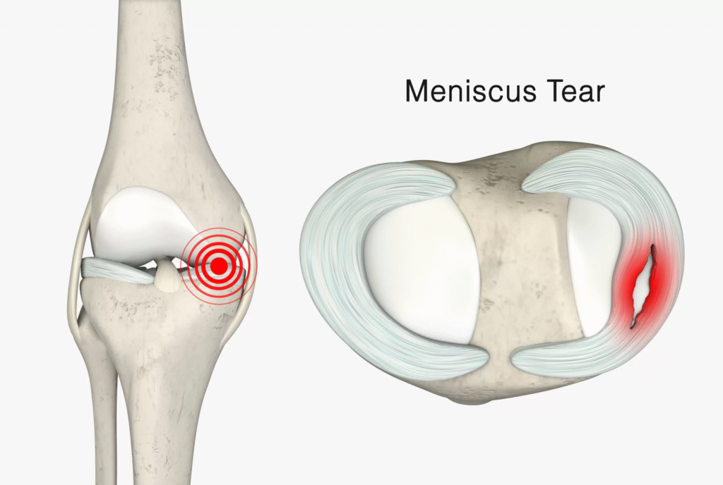 meniscal tear melbourne