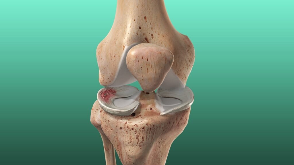 meniscal tear knee pain melbourne