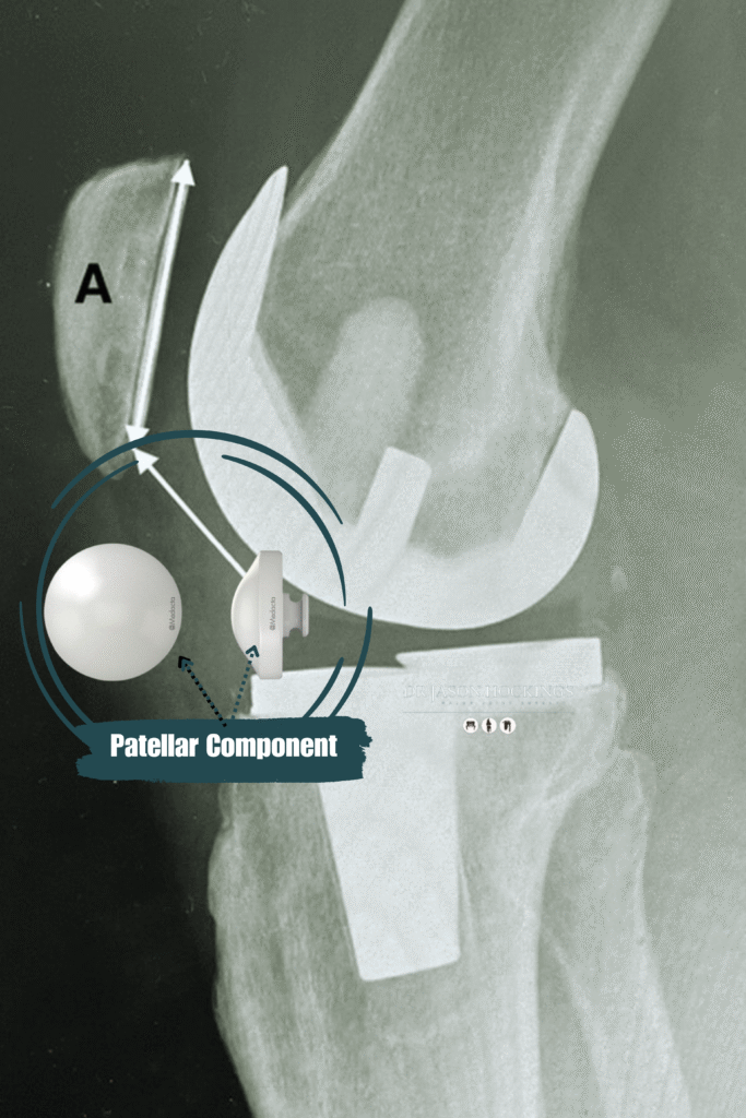 patellar component tka dr jason hockings