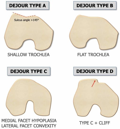patellofemoral instability melbourne