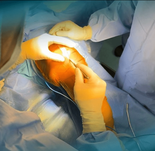 subvastus tka approach melbourne