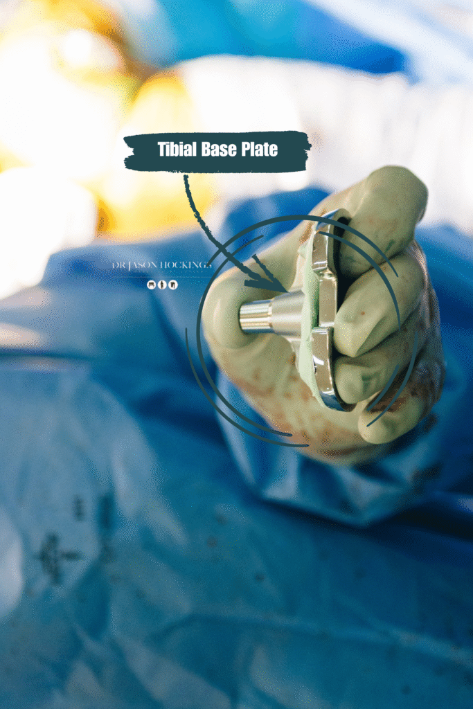 tibial base plate tka dr jason hockings