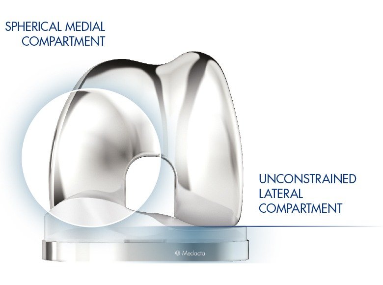 gmk sphere medial pivot implant