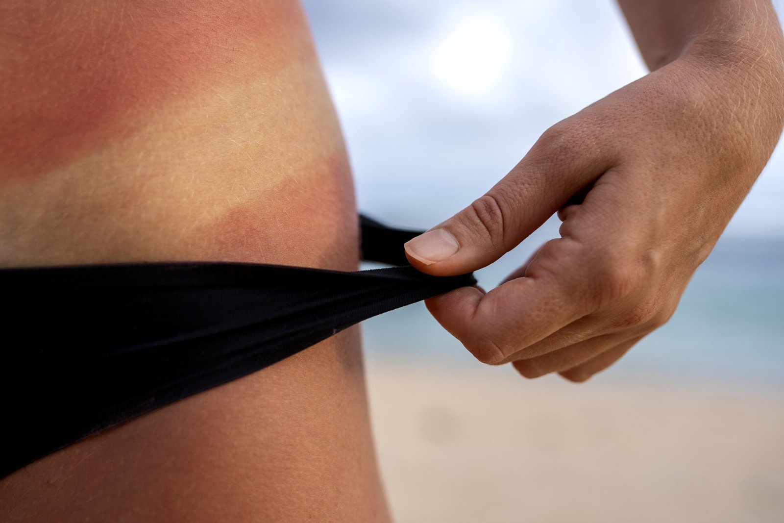 view woman s sunburn skin from wearing bikini