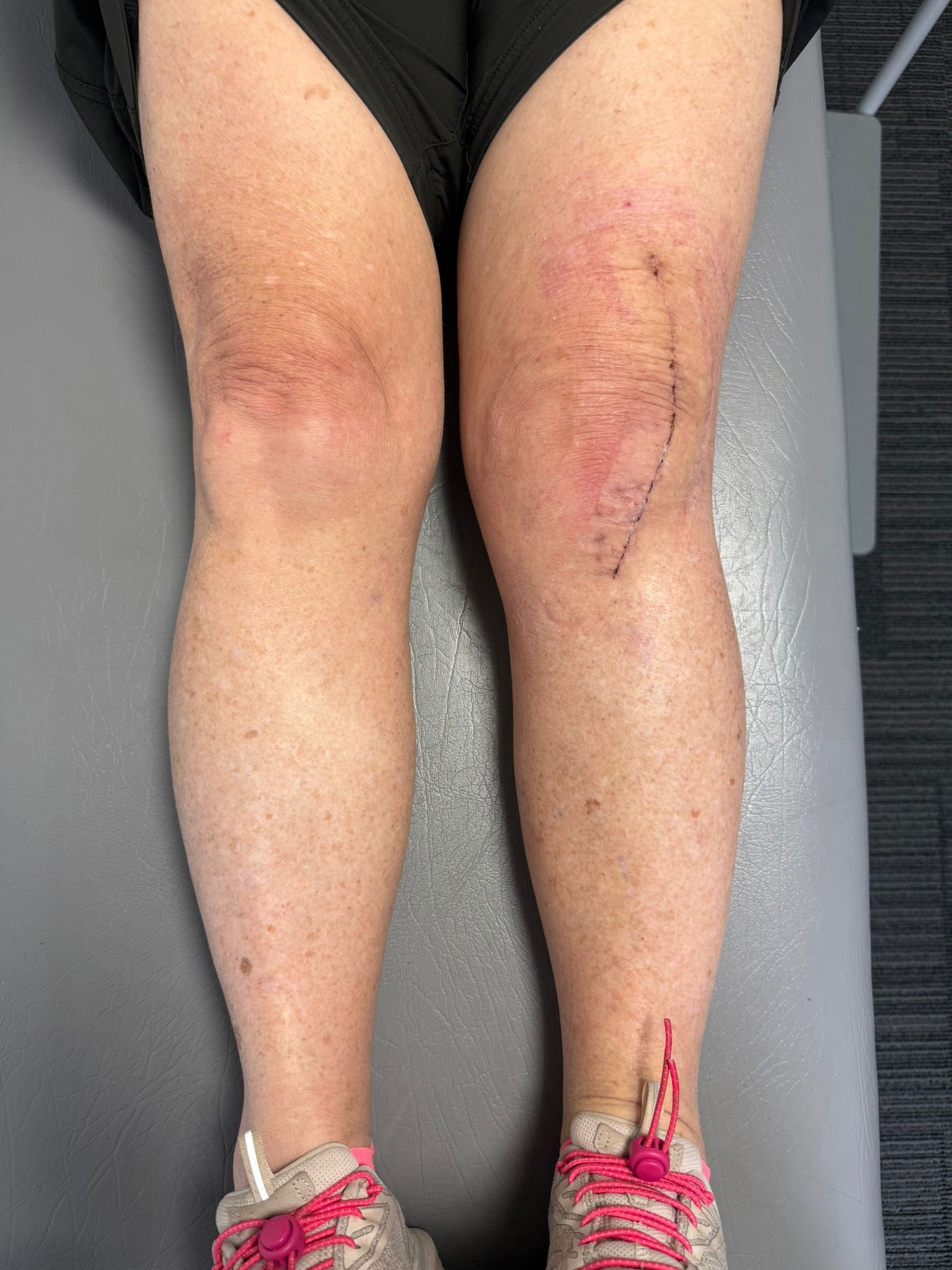 Subvastus approach TKA Melbourne
